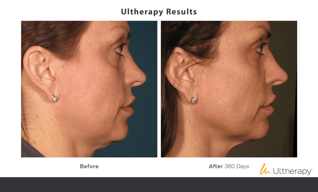 Ultherapy San Diego